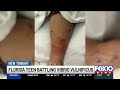 Florida teen fights ‘flesh eating bacteria’