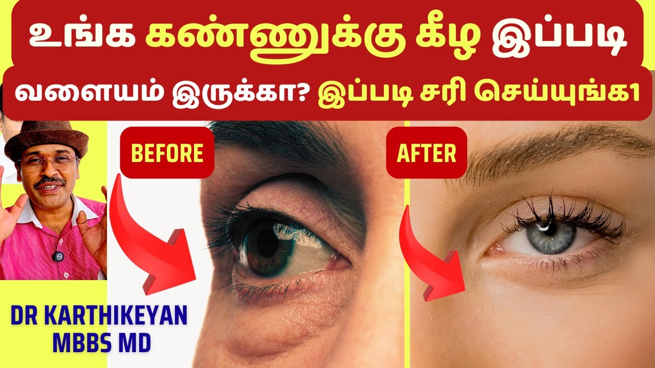 கண்கள் கருவளையம் உடனே நீங்க டிப்ஸ்|dark circles under eyes home remedies dr karthikeyan