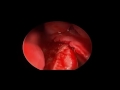 Septoplasty