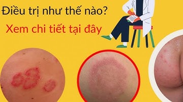 Bạn bị hắc lào (lác đồng tiền) lâu năm phải xem clip này để điều trị