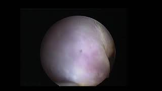 Amazing Hysteroscopy by Shawki, pedunclated myoma into vagina