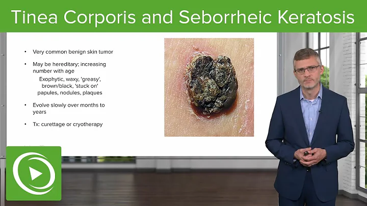Tinea Corporis (Ring Worm) and Seborrheic Keratosi...