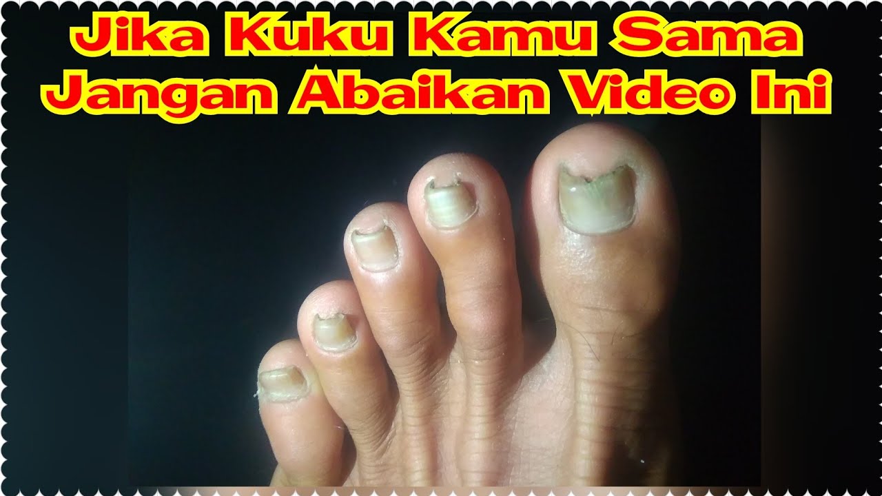 Menakjutlan. Beginilah Cara Mengatasi Cantengan Di Kaki