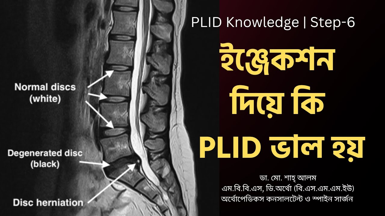 PLID 6 | ইঞ্জেকশন দিয়ে কি PLID ভাল হয় | PLID By Epidural Injection | Doctor Shah Alam