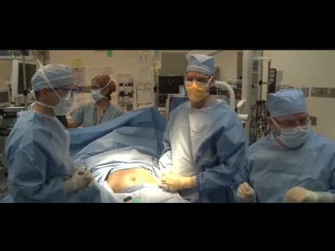 Laparoscopic Sleeve Gastrectomy Video - Brigham and Women&rsquo;s Hospital