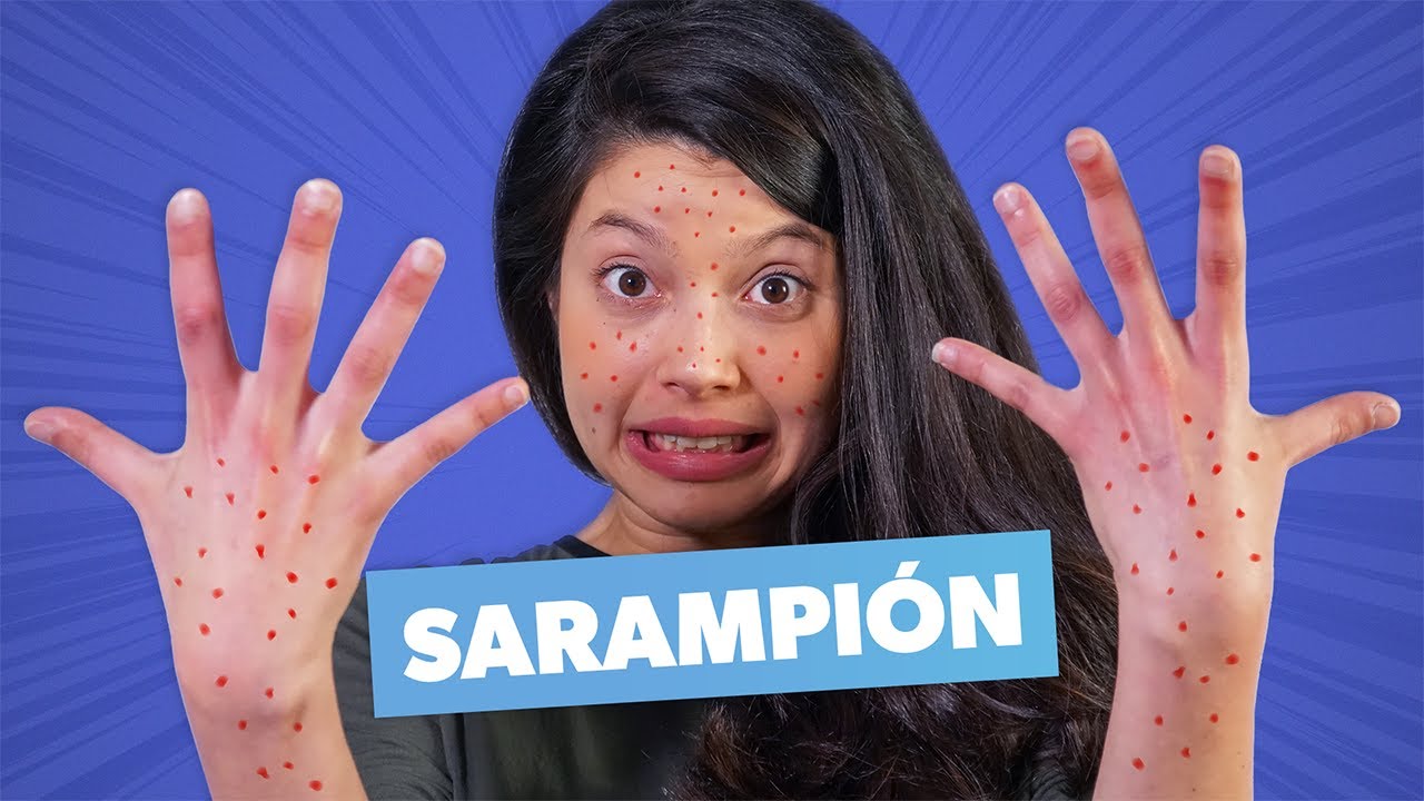 youtube image - Sarampión: todo lo que debes saber