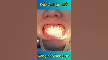 Đố Các Bạn Biết Răng Nào Hỏng Tủy | Bác Sĩ Cường #bacsicuong #rangsu #viemtuyrang #rangsuthammy