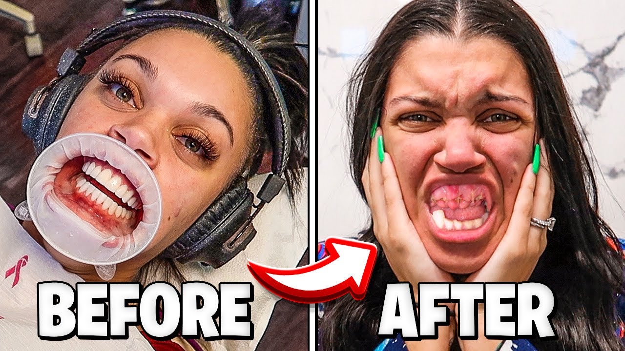 MY TEETH GOT RUINED FOREVER **VENEERS EXPERIENCE** YouTube