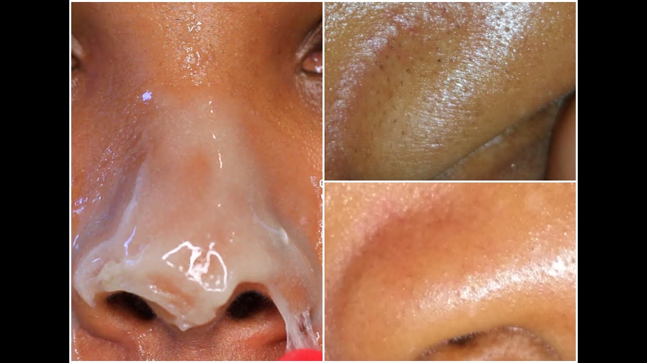 Pinterest DIY Black head strip ? First attempt! - Queenii Rozenblad