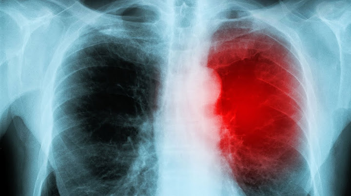 Which physiological condition of a patient prescribed clozapine would the nurse monitor