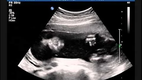 Baby Enzenbacher 20 week scan
