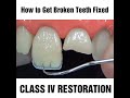 How to fix a chipped cracked or broken tooth mydentcart  cracked tooth repair  broken tooth