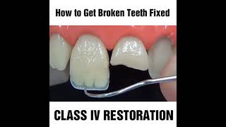 How To Fix A Chipped Cracked Or Broken Tooth Mydentcart Cracked Tooth Repair Broken Tooth