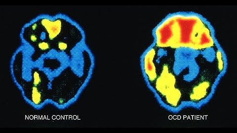 Biological Differences in Patients with OCD