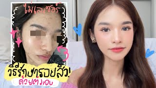 HOW TO กู้ผิวจากรอยสิว รอยแดง รอยดำ ให้กลับมาดีขึ้น แบบเห็นได้ชัด (NO SPON)