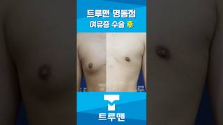 깔끔한 트루맨 명동점의 여유증 수술 경과