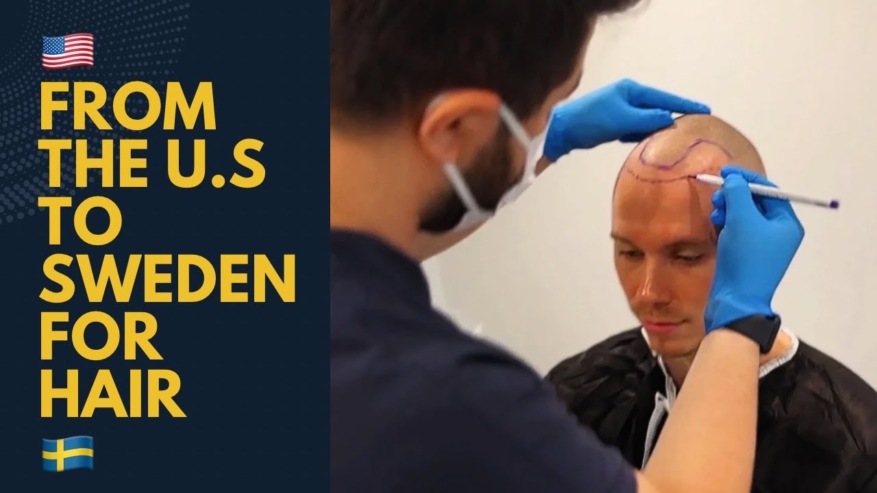 American Cancelled His U.S Hair Transplant (and came to Sweden)