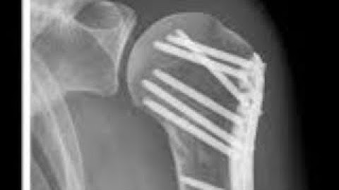 fixation of proximal humerus fracture with philos plating