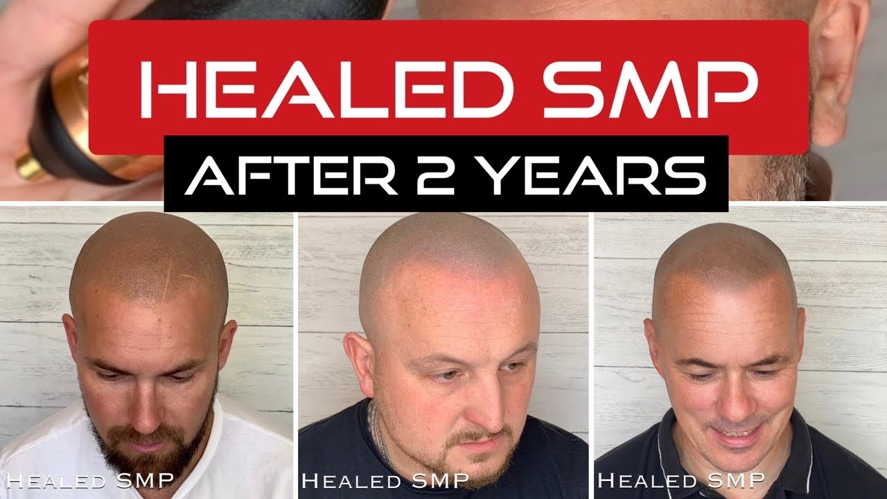 scalp micropigmentation