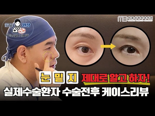 [성형외과전문의] 무조건 10년 이상 젊어집니다;; 꺼진눈 + 눈밑지방 케이스리뷰