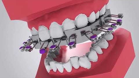 GuideMia Direct Bonding Guide annimation video