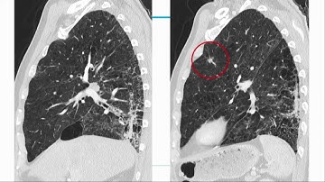 Intelligent Healthcare in CT imaging - Matthias Prokop