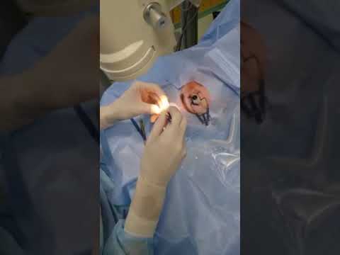 Операция по лечению катаракты, cataract surgery