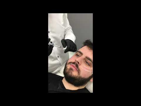 Βίντεο: Πώς να αντλήσετε τα ζυγωματικά στο πρόσωπό σας χωρίς χειρουργική επέμβαση