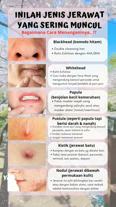 Inilah macam-macam jerawat dan cara mengatasinya #jerawat #tips #shorts #short