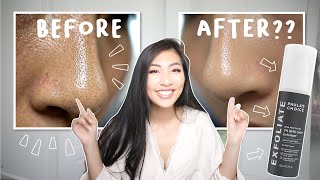 Remove blackheads on nose?! | Paula&#39;s Choice BHA exfoliant before and after