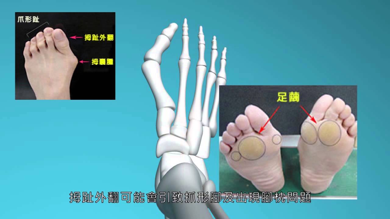 拇趾外翻, 拇趾外翻原因, 拇指外翻原因 - 拇趾外翻專科診療中心 (上) - YouTube