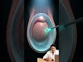 अंडकोष में सूजन लेकिन दर्द नहीं? यह हाइड्रोसील हो सकता है | Hydrocele Symptoms Explained #shorts