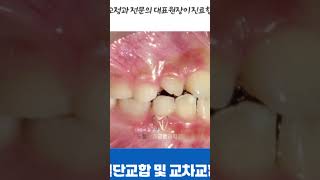 #양산치아교정 절단교합 및 교차교합