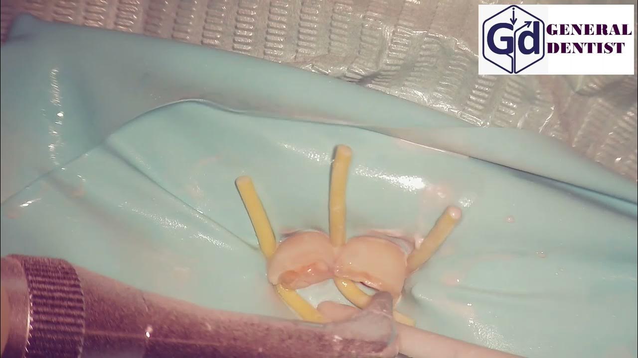 Sandblasting with aluminium oxide ,(30 microns). Vertical erasability