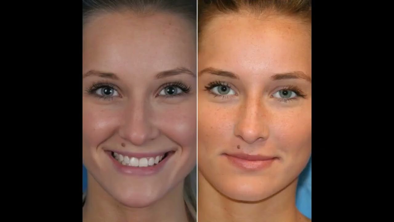 Facial Plastic Surgeon Macomb Michigan - Rhinoplasty Michigan