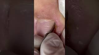 UNHA ENCRAVADA INGROWN TO REMOVE NAIL  [Renata Werneck Podóloga - Unha Encravada] TOE BRO #shorts