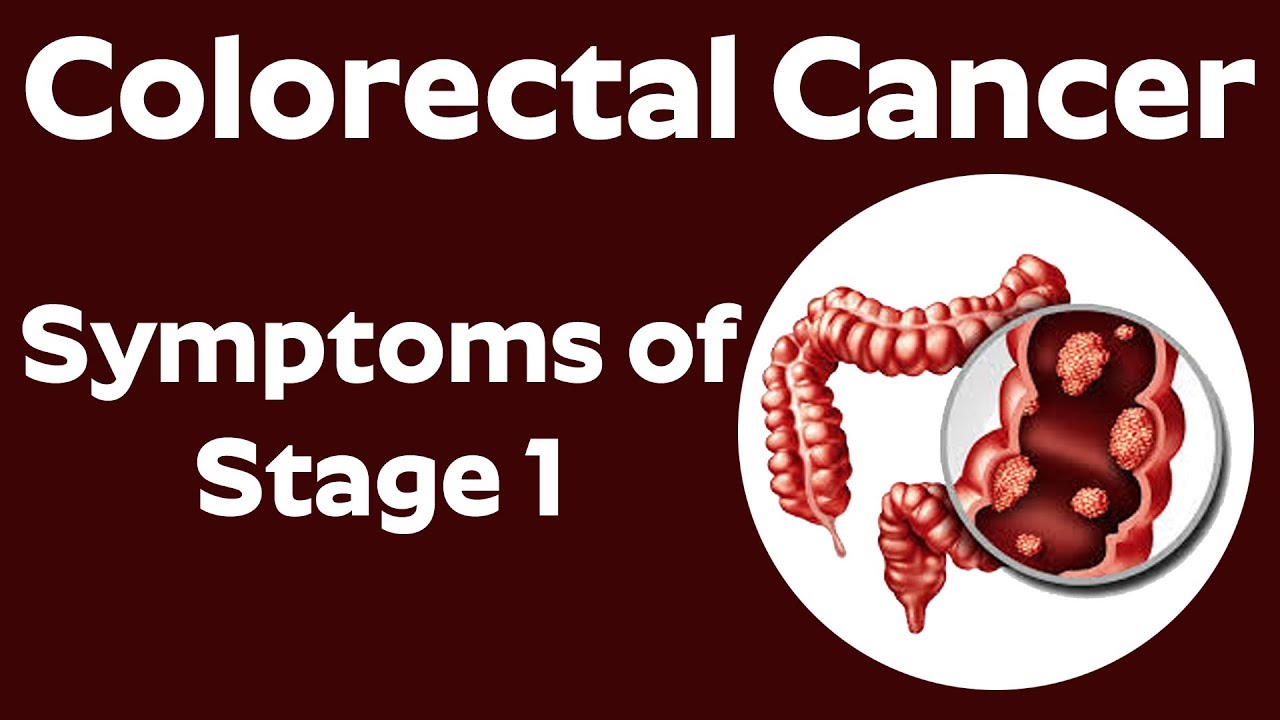What Is Colorectal Cancer What Are The Symptoms Of Stage 1 Colon