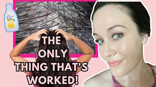 How I QUICKLY got rid of my itchy, dry scalp within ONE WEEK -(eczema and psoriasis)