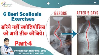 scoliosis exercises, बिना सर्जरी कमर के टेडापन का इलाज ॥ back pain exercises part 4 ||