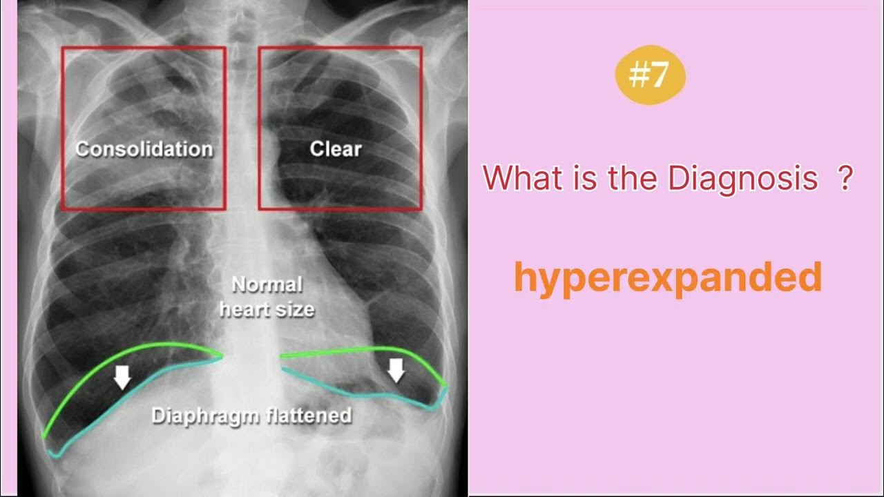 Chest x ray quiz 7 ( hyperexpanded) radiologychannel007 YouTube