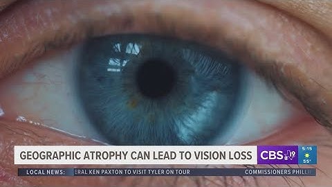 Geographic atrophy can lead to vision loss