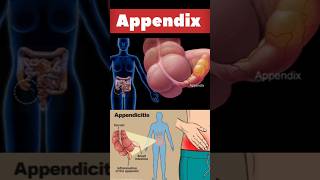 Appendix kya hota hai hindi mein#पेट के इस दर्द कोIgnore मत #youtubeshorts#appendicitis#appendix