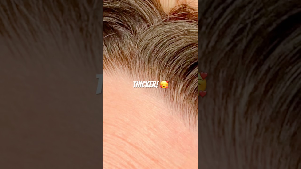 Thicken your hair in midlife with targeted lasers!