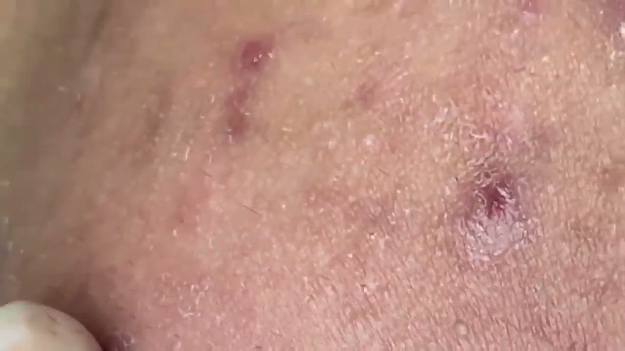 BLACKHEAD PIMPLES REMOVAL ACNE OF THE ELDERLY IN CAN THO T4BLACKHEAD
