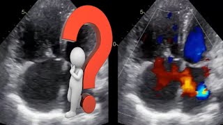 Partial anomalous pulmonary venous return echocardiography (PAPVR)
