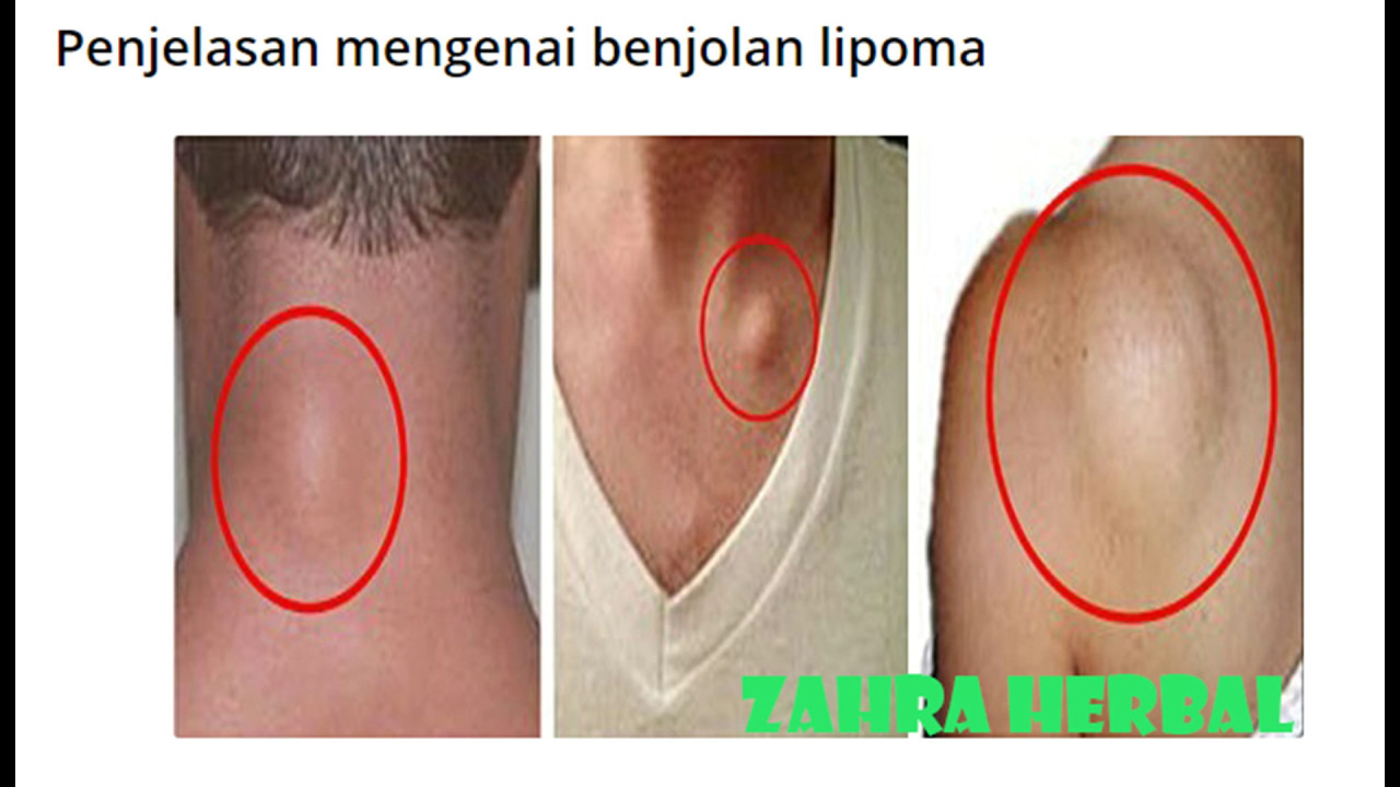 Cara Mengobati Lipoma Dengan Bawang Putih Cara Mengobati Lipoma Dengan Bawang Putih