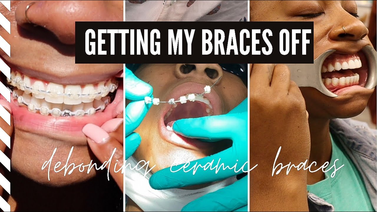 BRACES BEFORE AND AFTER getting my braces off ceramic braces