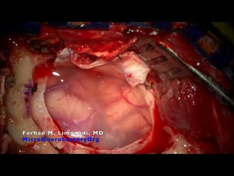 Surgical resection of vascular lesion affecting speech area. Patient's story and technical points.