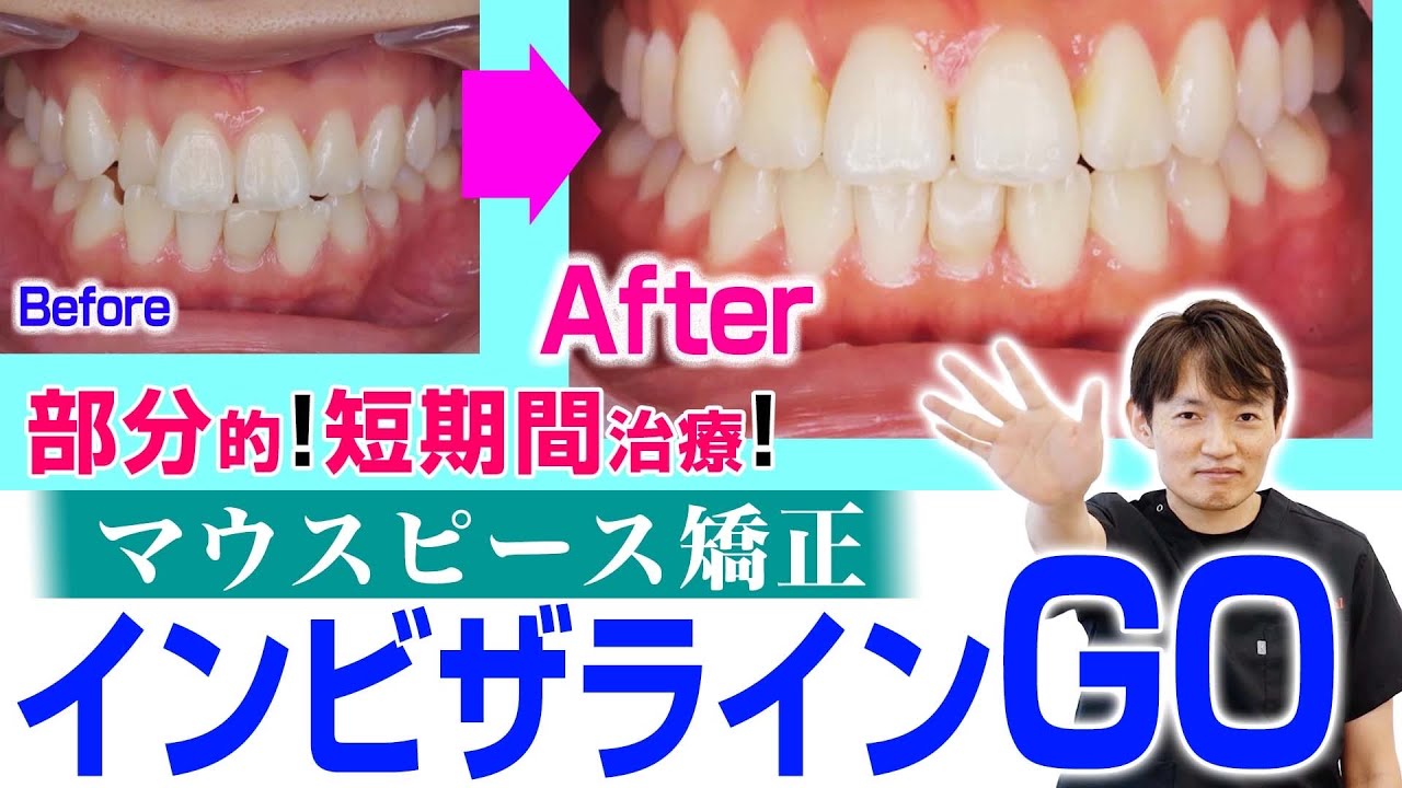 【マウスピース矯正】治療期間4カ月？！インビザラインGOの解説と共にビフォーアフターお見せします！