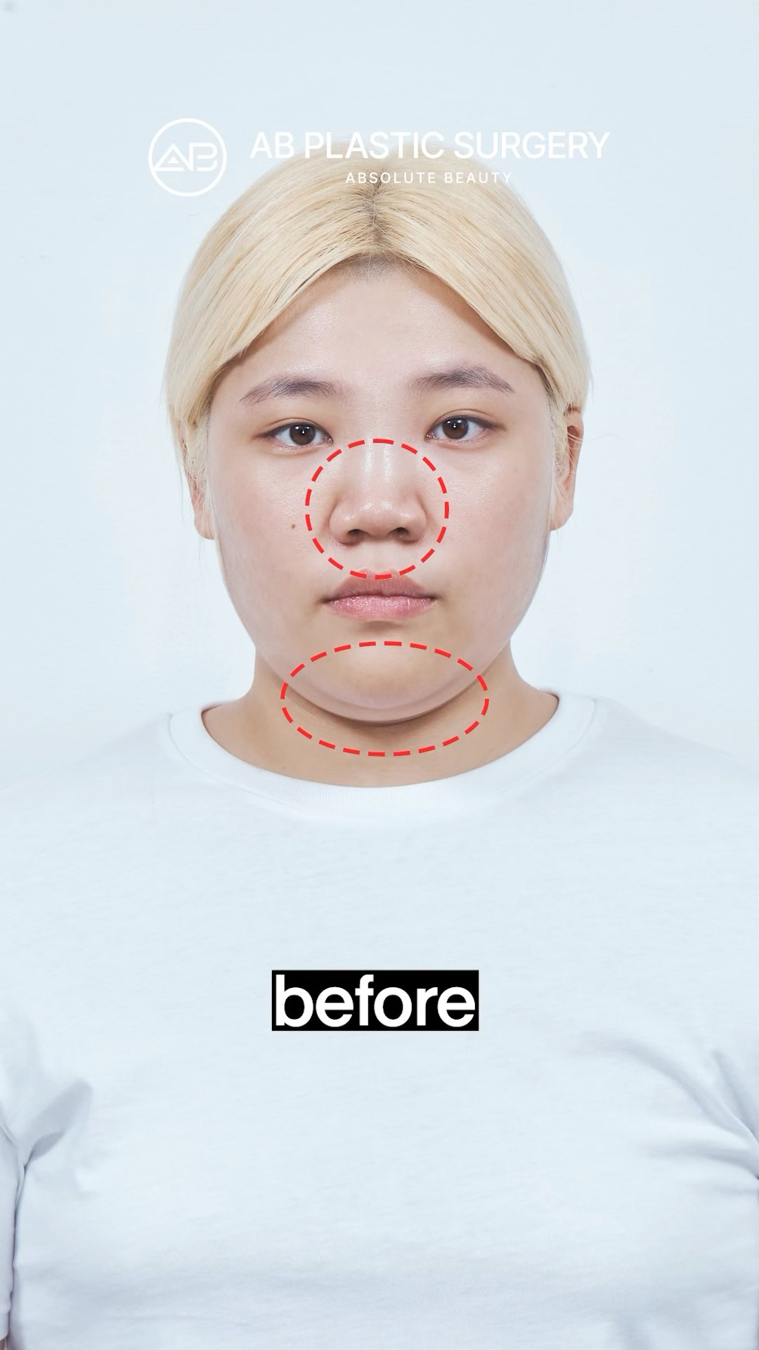 Full Face Makeover in Korea (Nose, Contour, Lipo) #koreanplasticsurgery